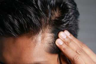 La caída del cabello en hombres: Por qué muchos buscan información sobre Minoxidil y alternativas naturales